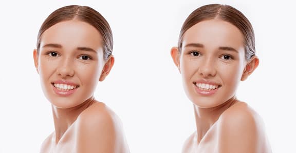 Prominent Ear Aesthetics (Otoplasty)