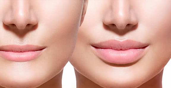 Dudak Kaldırma (Lip Lift)